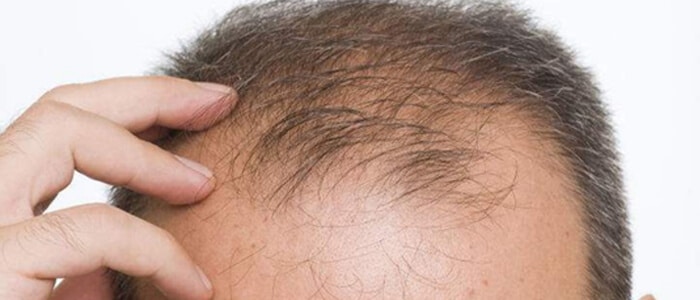 Hair Loss Causes and Solutions