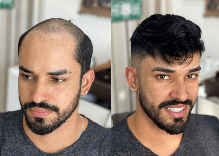 Hair-System-BeforeAfter