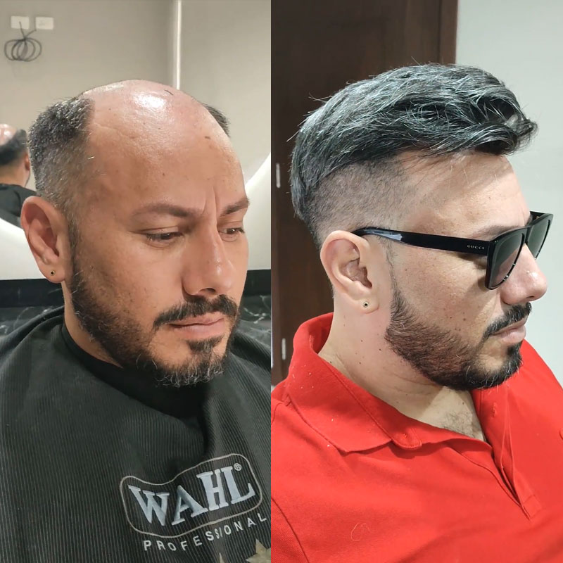 HS1VP 40% Grey Hair hair system before and after