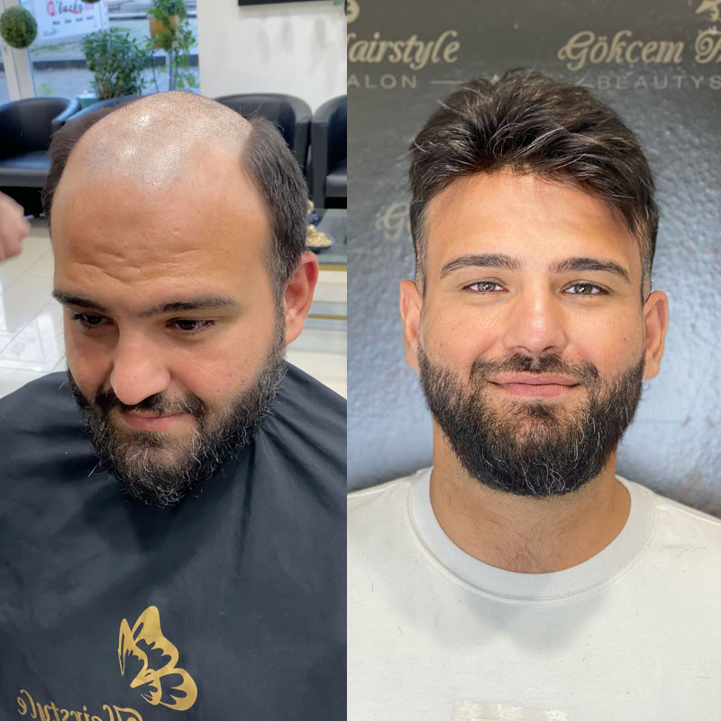 hs27+ hair system before and after