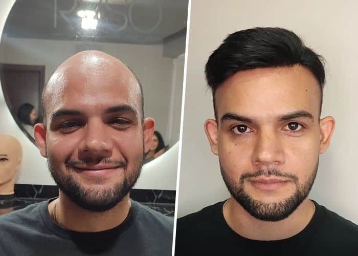 toupee-install-beforeafter-3