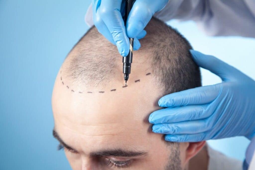 How-to-Fix-Receding-Hairline-hair-transplant