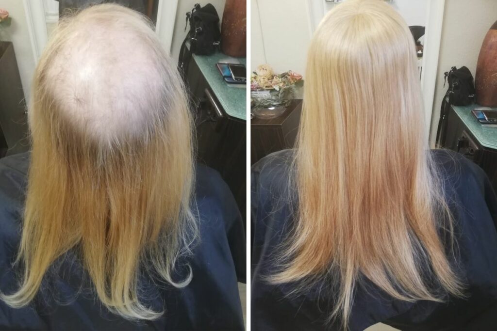 hair-extension-for-balding-crown-beforeafter-custom-hair-system