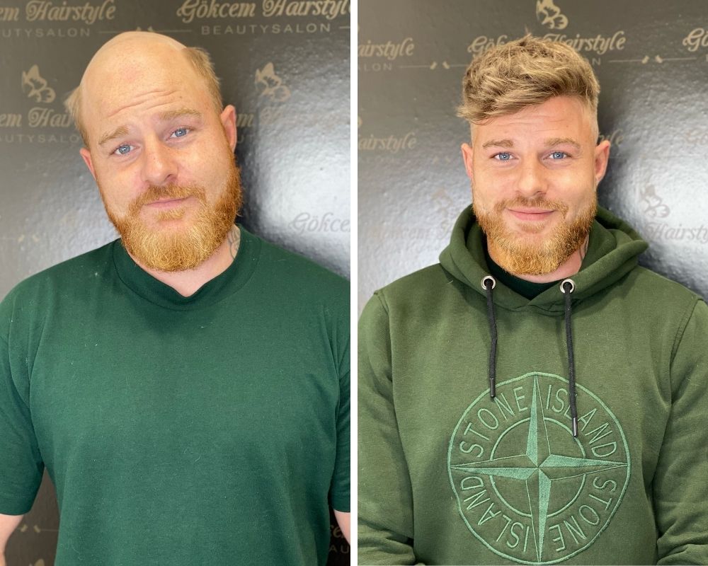 Before and after a New Times Hair client has a hairpiece attached to his head