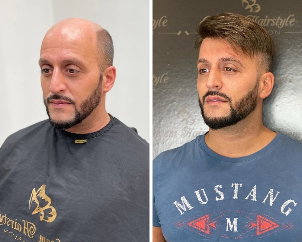 hair system for balding men before and after