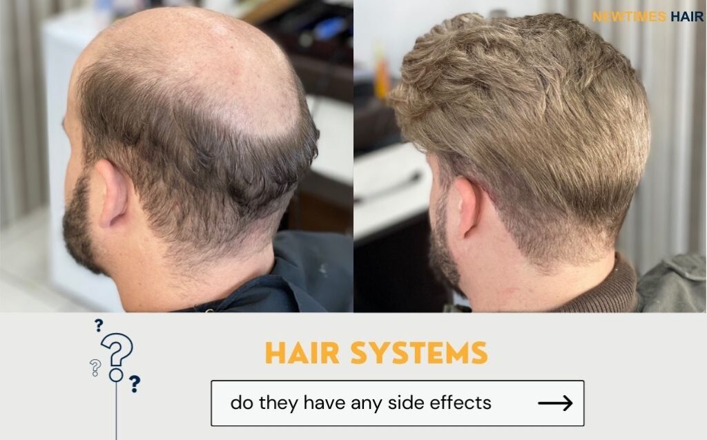 Before and after a man has a hair system attached 