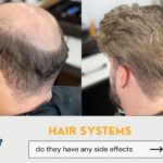 HAIR SYSTEM SIDE EFFECTS