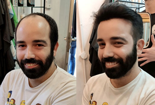 mens hair systems Before and after 1