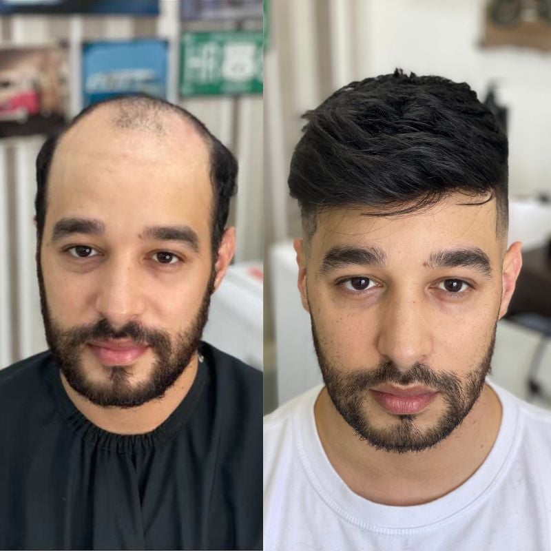 mens hair systems before and after new times hair (3)