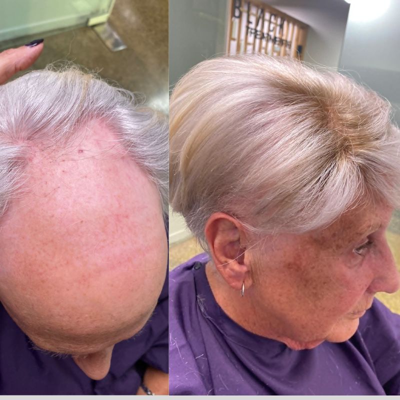 womens toupee before and after new times hair